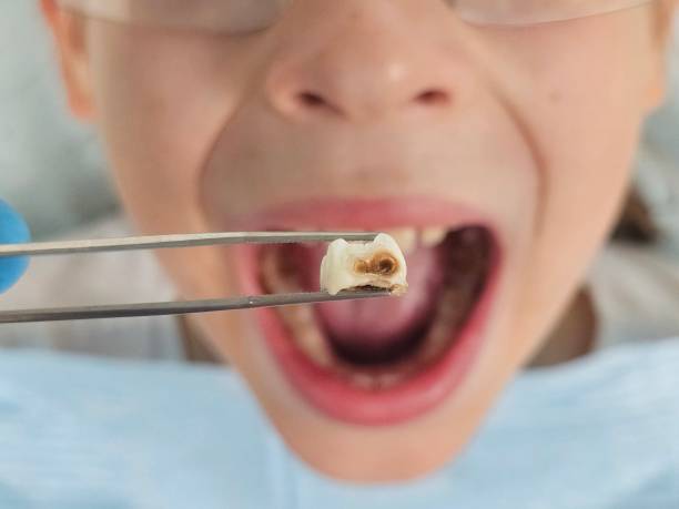 Best Emergency Treatment for Toothache in Georgetown, SC